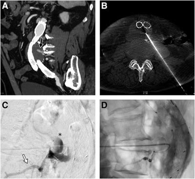 Translumbar type II endoleak embolization with a new liquid iodinated polyvinyl alcohol polymer: Case series and review of current literature